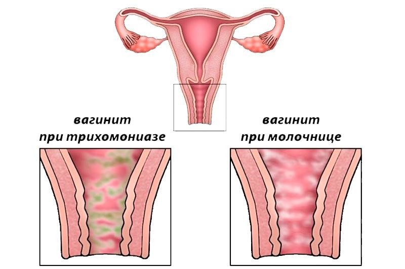 Полижинакс вагинальные капсулы фармакокинетика