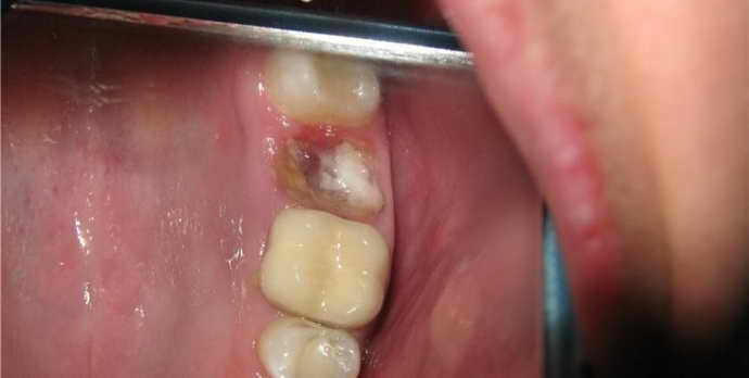 Альвеолит как причина температуры после удаления зуба