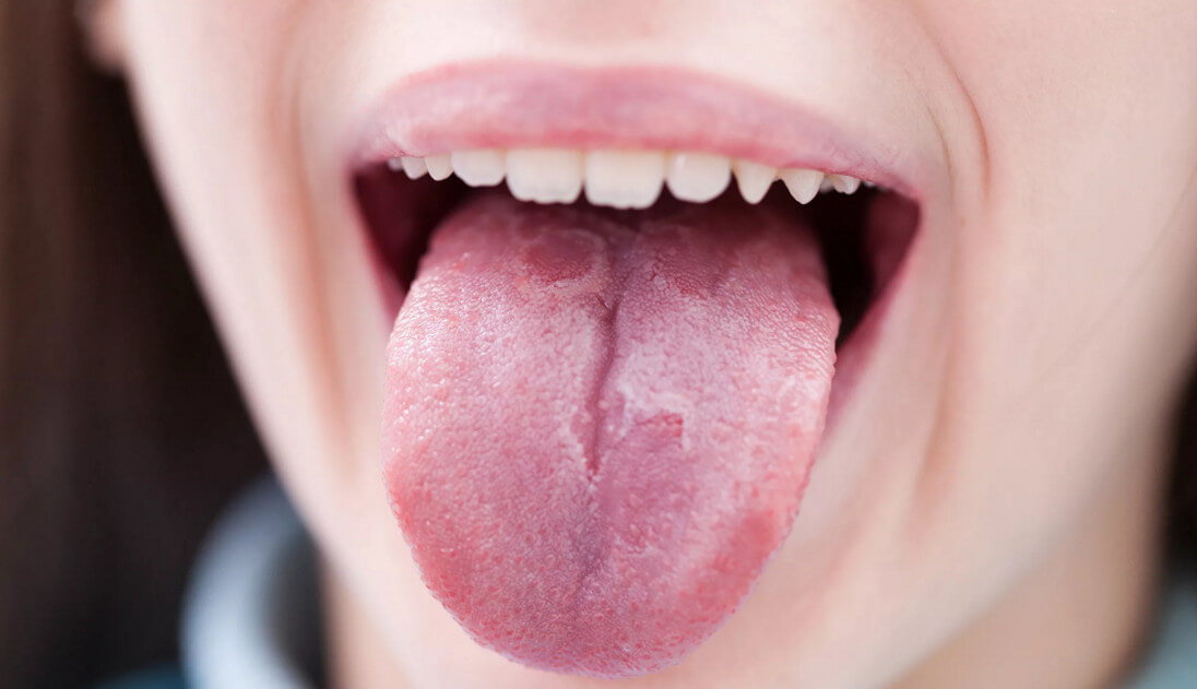 Что такое глоссит языка и почему он возникает