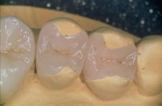 Что такое керамическая вкладка в зуб
