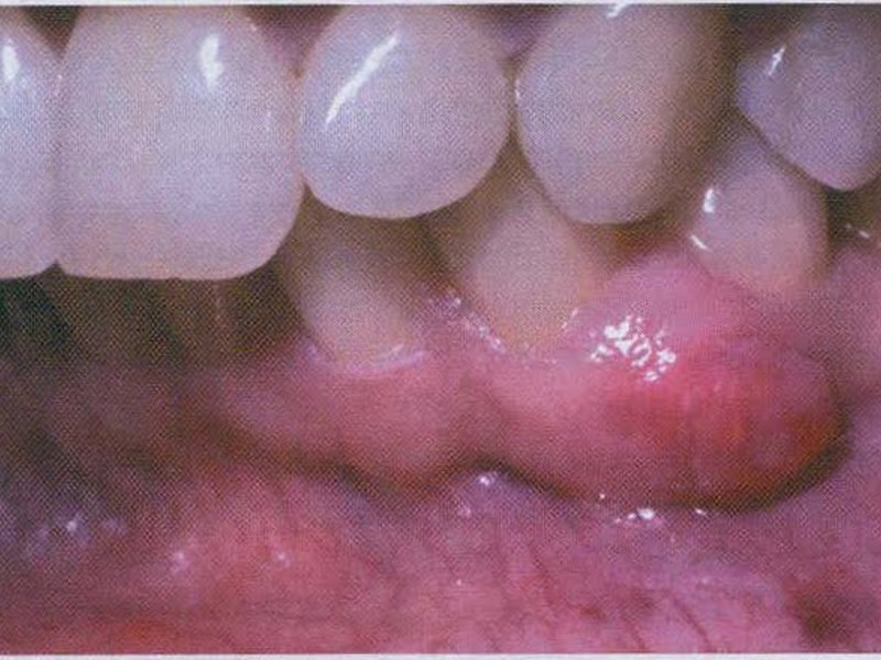 Что такое кистогранулема зуба
