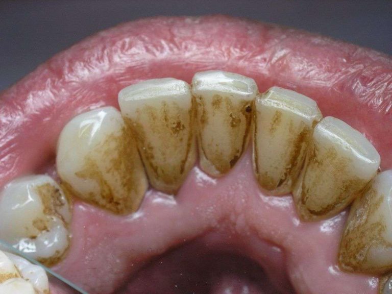 Что такое зубной камень и чем он опасен для зубов