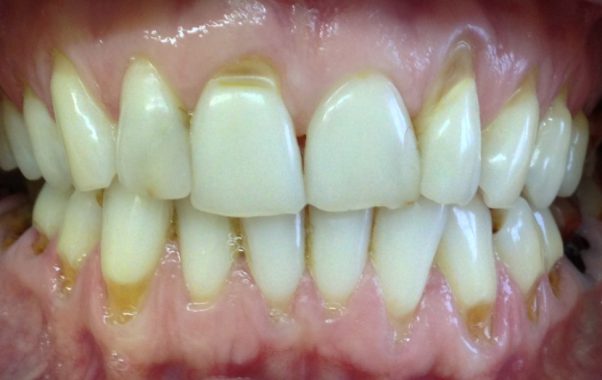 дефекты на зубах после отбеливания