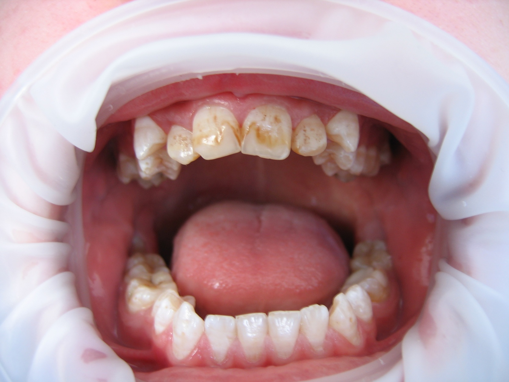 Флюороз как некариозное поражение зубов