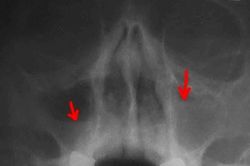 Гайморит на снимке рентгена как выглядит, фото и описание