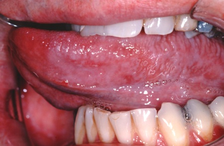 Глоссит как причина болячек под языком