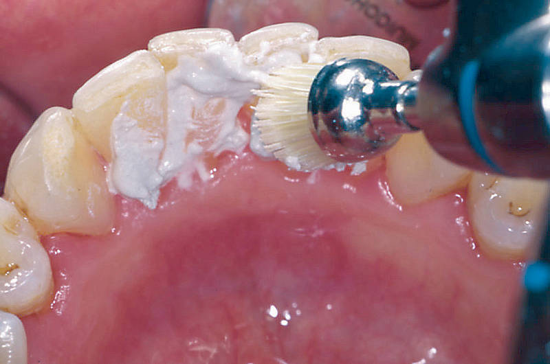 Химическая чистка от зубного камня больно ли это