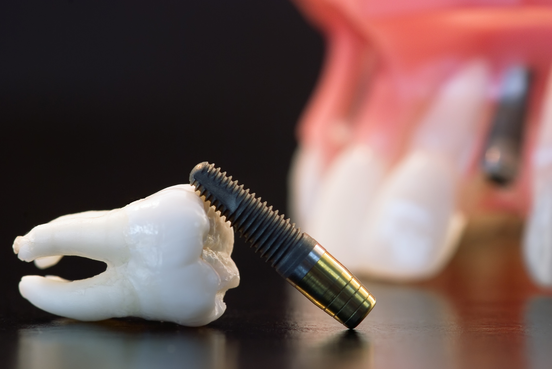Имплантация зубов без обточки