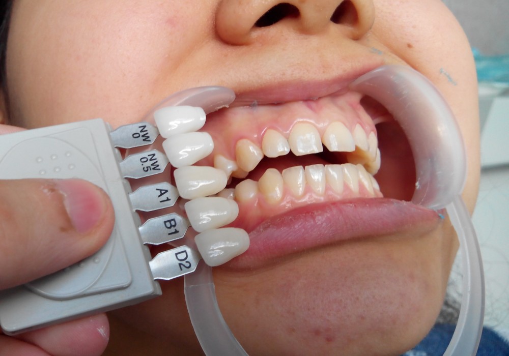 Как выбрать материал для протезирования передних зубов