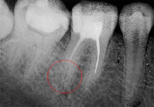 Канал запломбирован не полностью поэтому болит зуб после лечения пульпита