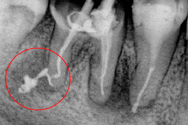 Канал запломбирован очень сильно поэтому болит зуб после лечения пульпита