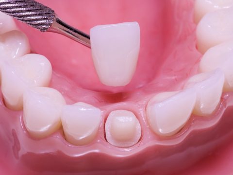 Керамическая зубная коронка