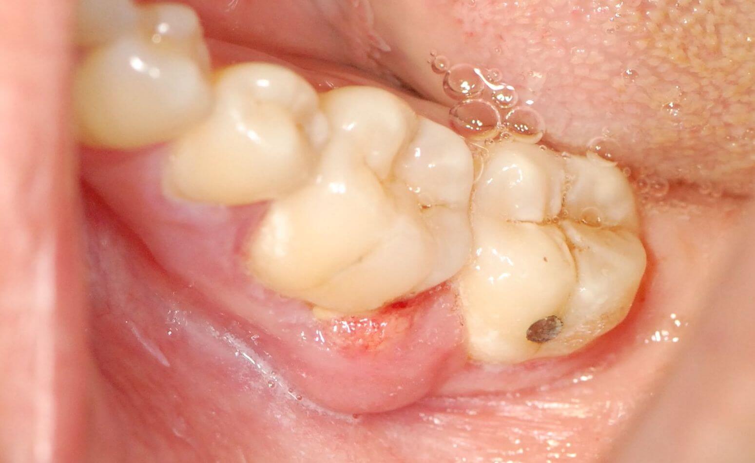 Киста зуба у ребенка из-за пародонтита