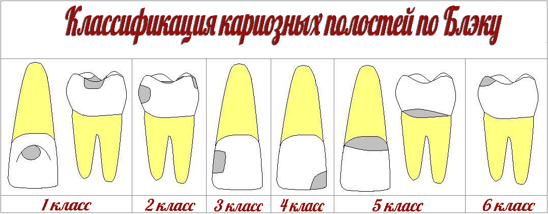 Классификация кариозных полостей по блэку презентация