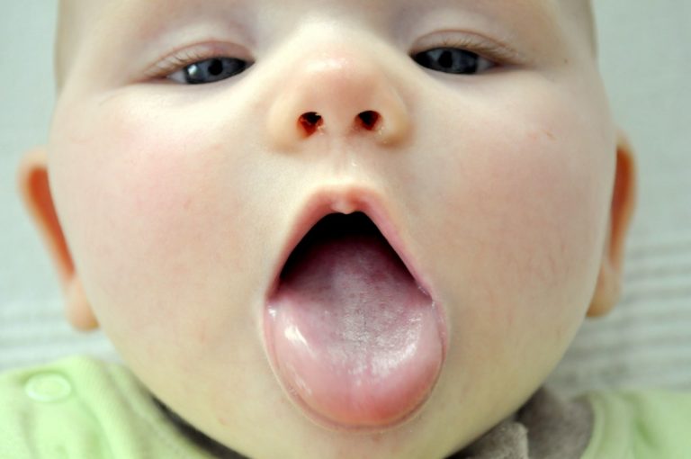 Когда налет на языке у малыша может считаться нормой