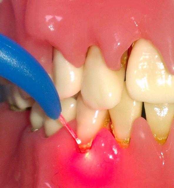 Лазерная чистка от зубного камня больно ли это