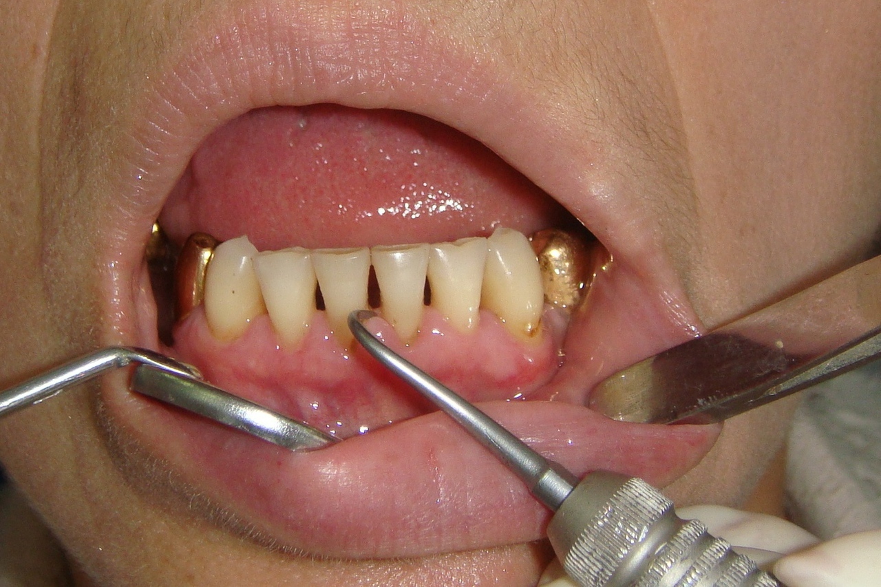 Механический способ очистки от зубного камня больно ли это