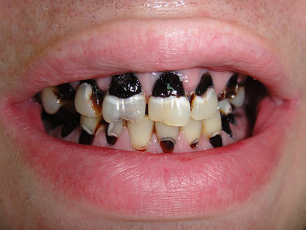Некроз твердых тканей зубов при некариозном поражении