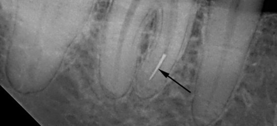 Обломался инструмент в канале поэтому болит зуб после лечения пульпита