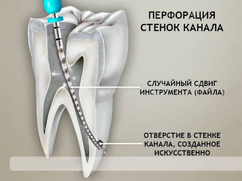 перфорации стенок зуба