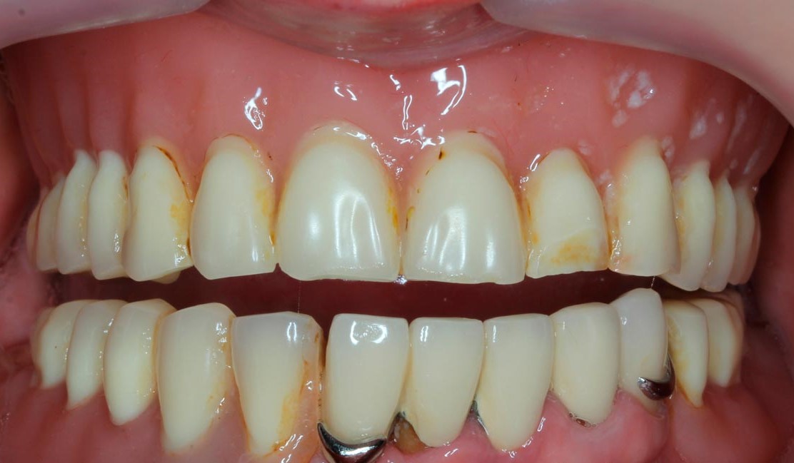 Почему темнее зубной протез