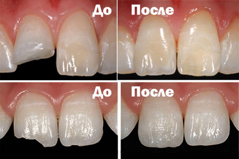 Показания и противопоказания к реставрации зубов