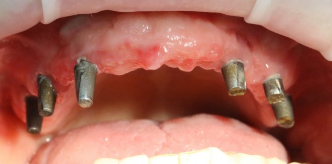 Применение базальной имплантации для восстановления верхнего ряда зубов