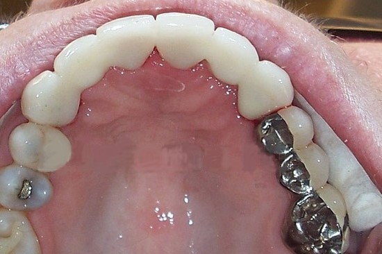 Шинирование подвижных зубов коронками