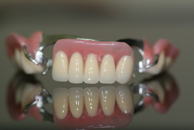 Съемное протезирование для передних зубов