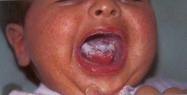 Симптомы гнойного стоматита у детей