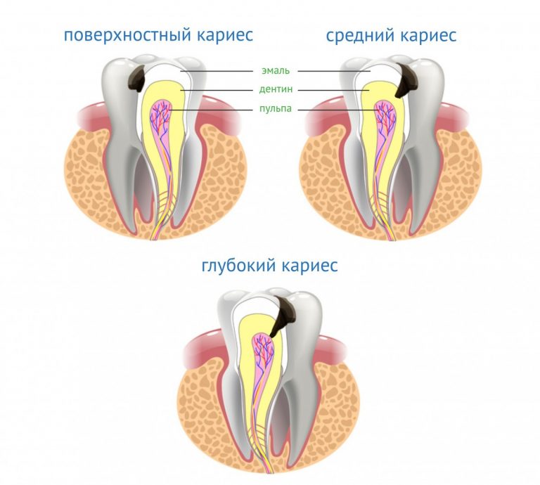 Клиническая картина остаточного пульпита