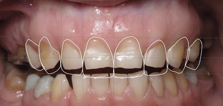 Стираемость зубов как некариозное поражение зубов