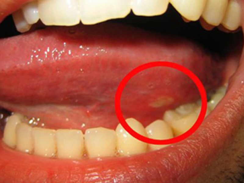Стоматит под языком основная причина появления болячек под языком