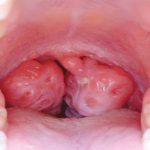 Причины покраснения слизистой полости рта
