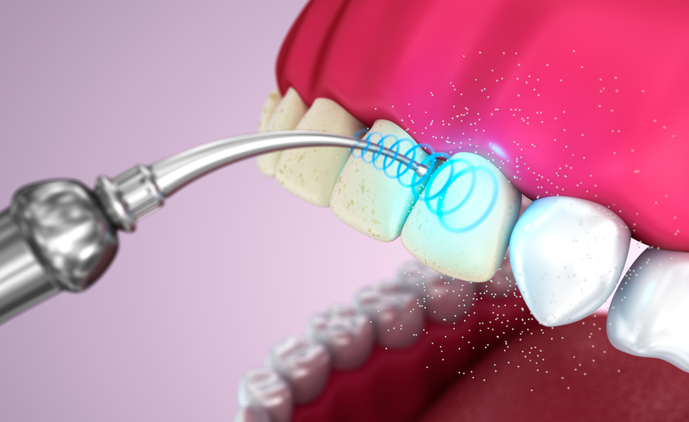 Ультразвуковая чистка от зубного камня больно ли это