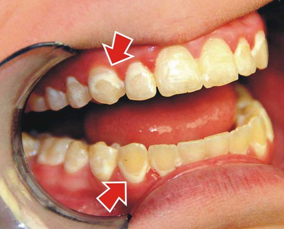 В чем очевидный вред брекетов для зубов