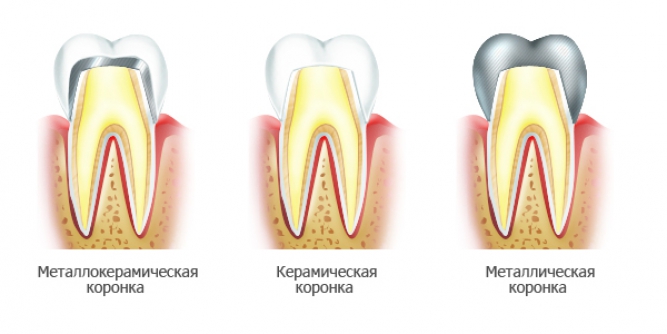 Виды зубных коронок для протезирования