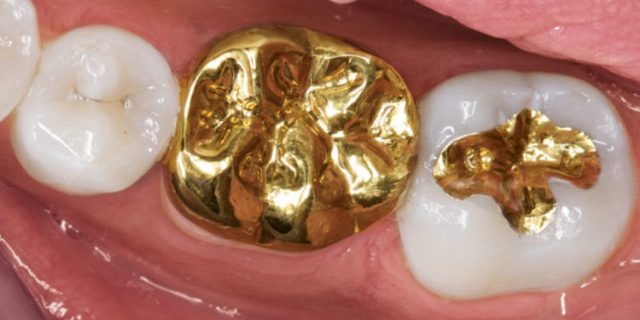 Золотая коронка на зубы