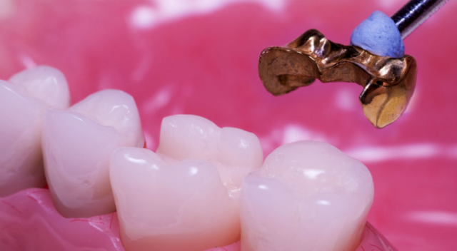 Золотая вкладка в зуб как способ восстановления зуба