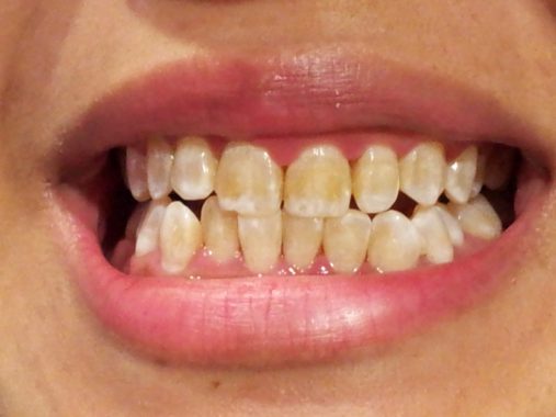 желтые зуба из-за отсутствия гигиены