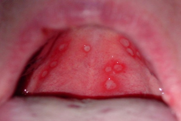 Аллергический стоматит языка