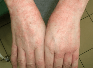 Понятие аллергической экземы: как её лечить