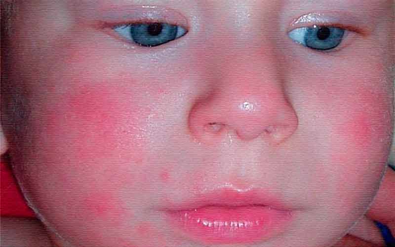 Симптомы дерматита у детей