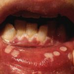 аллергический стоматит на губах