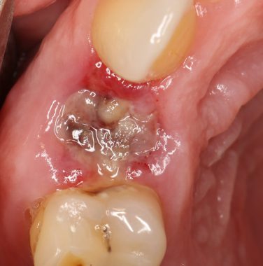 альвеолит в лунке зуба