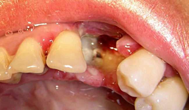 альвеолит в лунке зуба