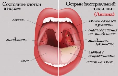Постоянно красное горло - лечение по советам доктора Комаровского
