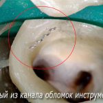 Почему появляется зубная боль после чистки каналов