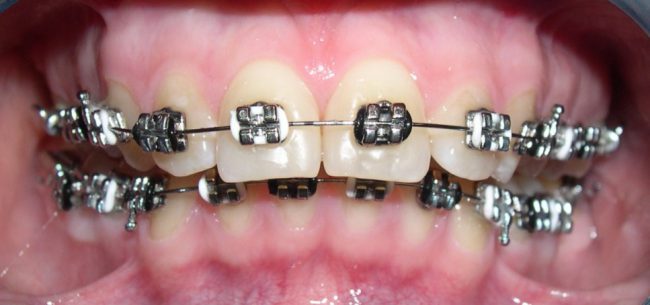 выравнивание зубов брекетами