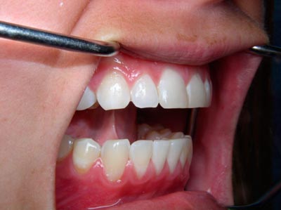 последствия скрипа зубами по ночам